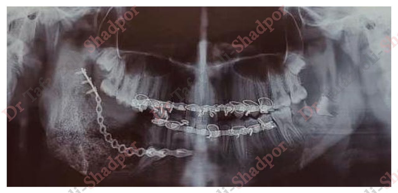  نمونه کار جراحی فک و صورت آقای دکتر حسین تفضلی شادپور 