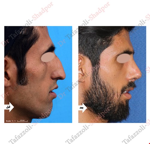 جراحی بینی آقای دکتر حسین تفضلی شادپور